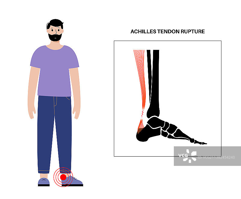 跟腱受伤图片素材