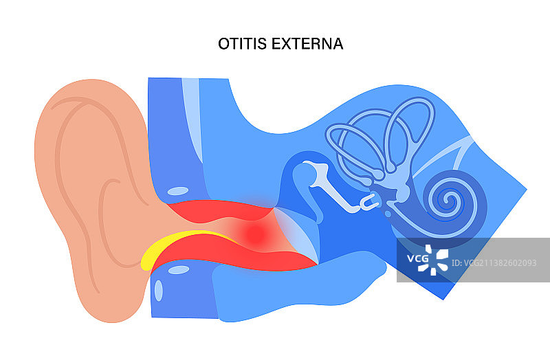 游泳性耳炎图片素材