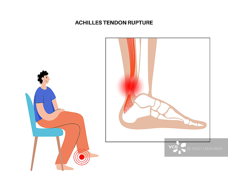 跟腱损伤图片素材