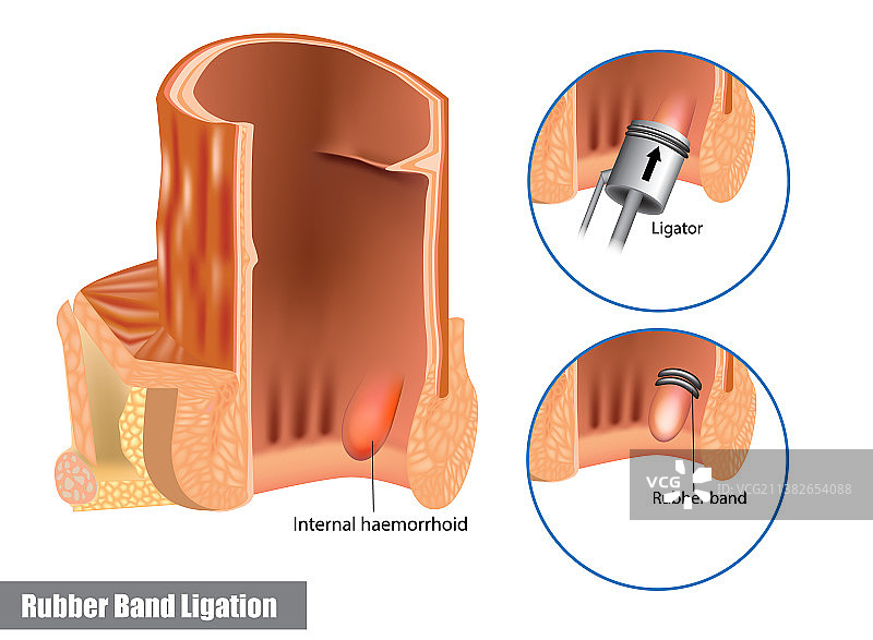 痔疮橡皮圈结扎术图片素材