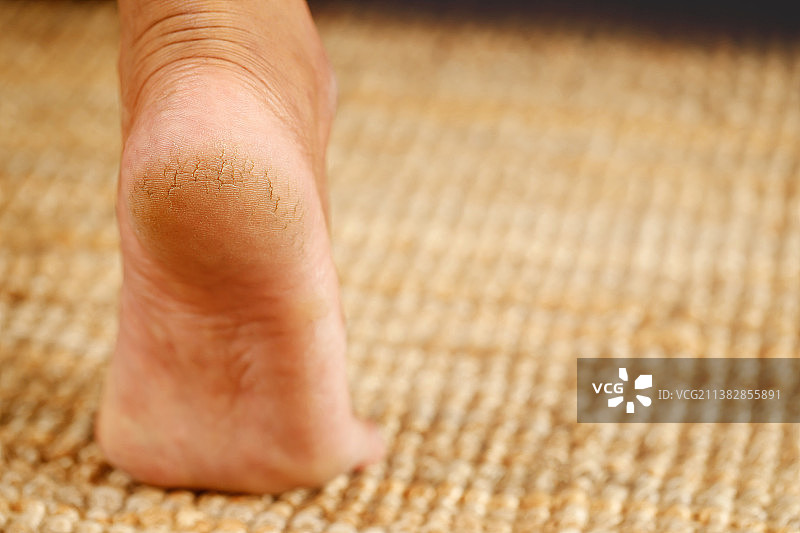 足跟龟裂护理，粗麻布上的黄麻袋特写图片素材