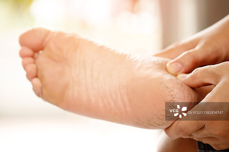 足部皲裂护理图片素材