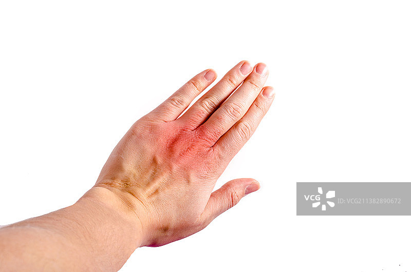 左手腕皮炎引起的皮肤刺激图片素材