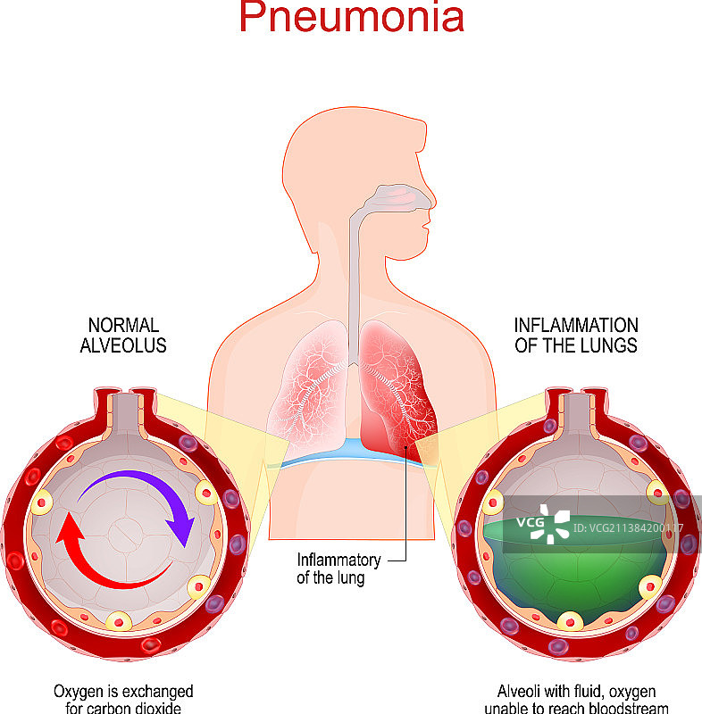 肺炎肺部感染，肺泡积液图片素材