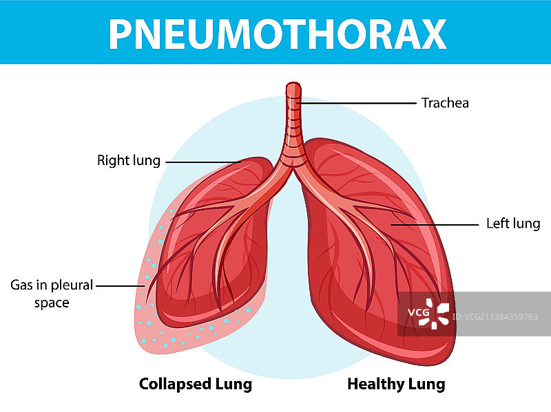 带肺部塌陷的气胸图图片素材