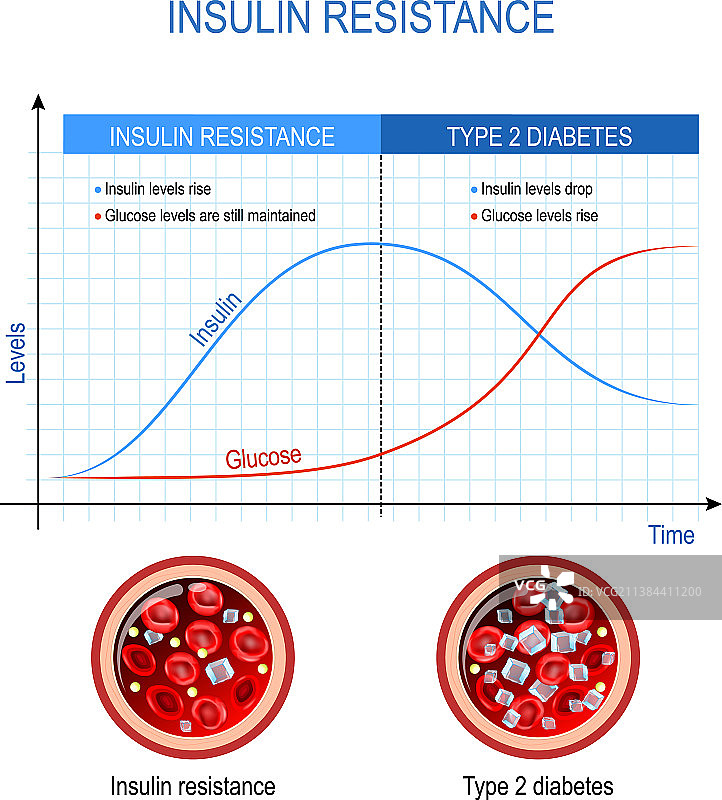 胰岛素抵抗与2型糖尿病图片素材