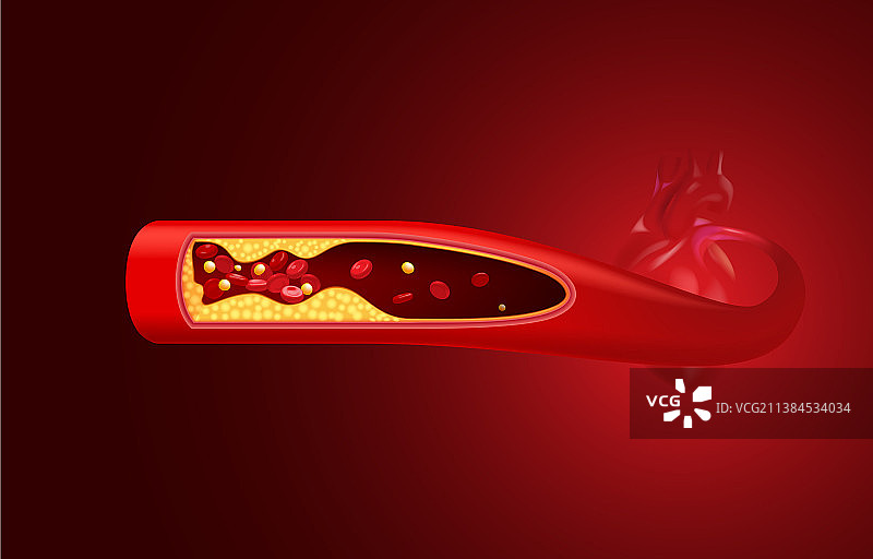 红色血细胞与胆固醇阻塞图片素材