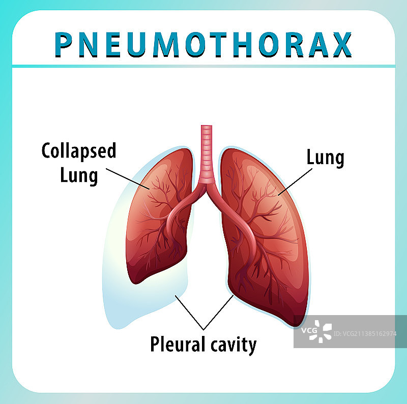 带肺部塌陷的气胸图图片素材