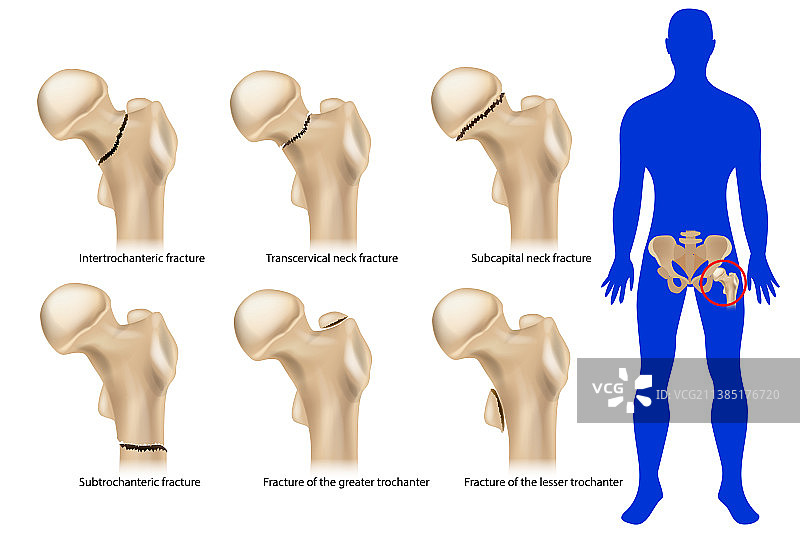 股骨颈骨折的髋部骨折类型图片素材