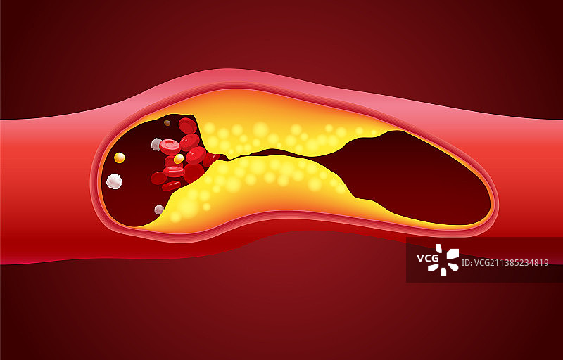 红细胞和胆固醇阻塞图片素材