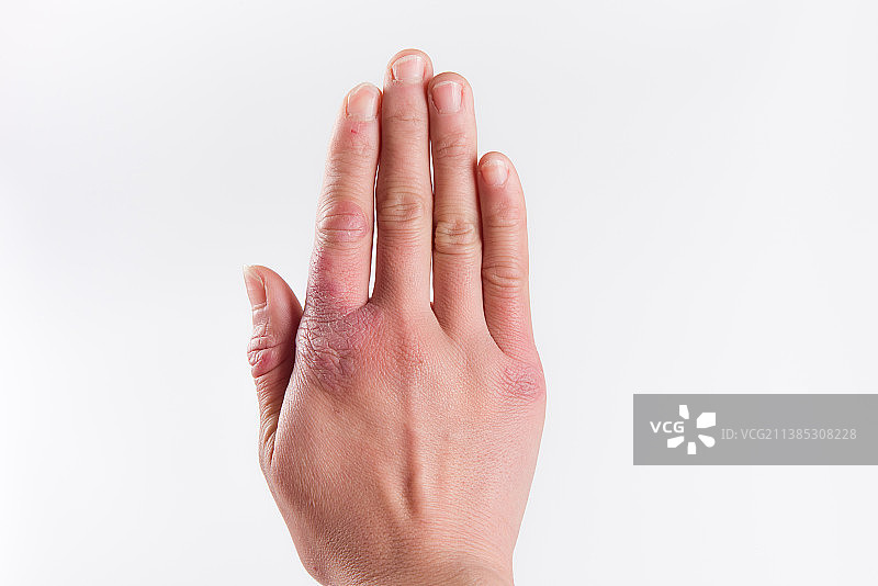 一只有冻疮的手图片素材