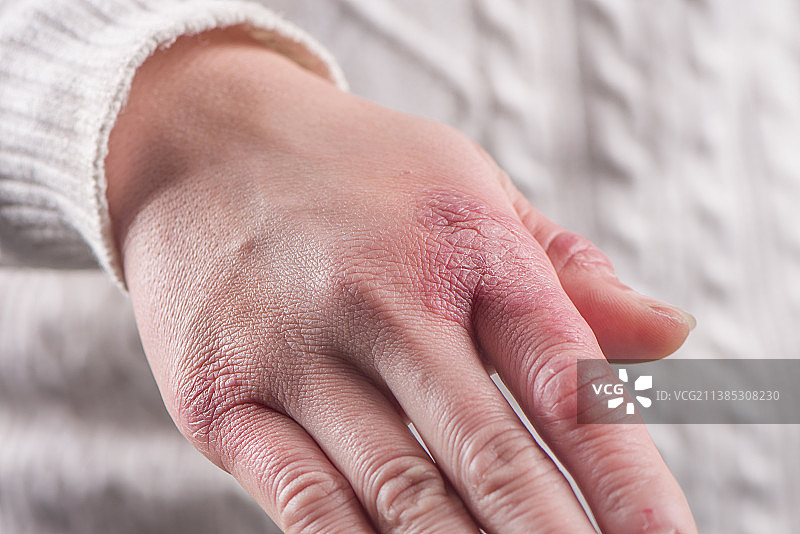 一只有冻疮的手图片素材