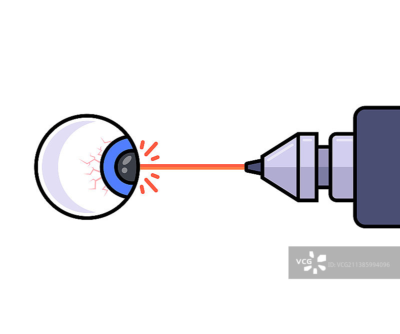 使用激光进行激光视力矫正图片素材