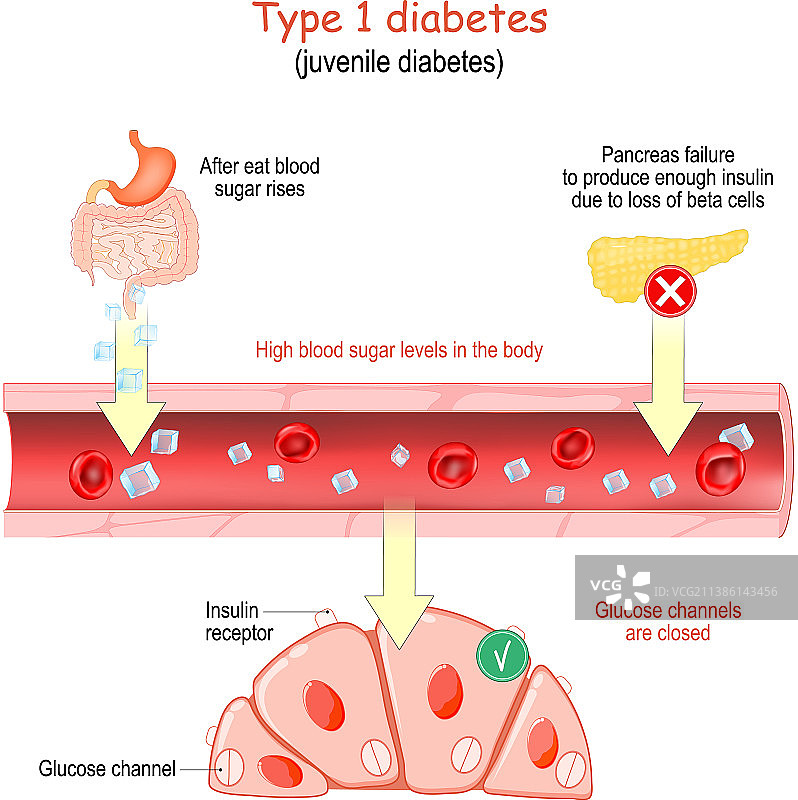 1型糖尿病青少年糖尿病图片素材