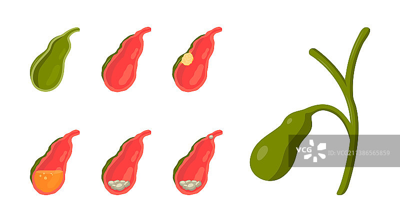 卡通风格的胆囊疾病图片素材