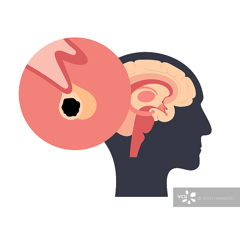 垂体腺瘤图片素材