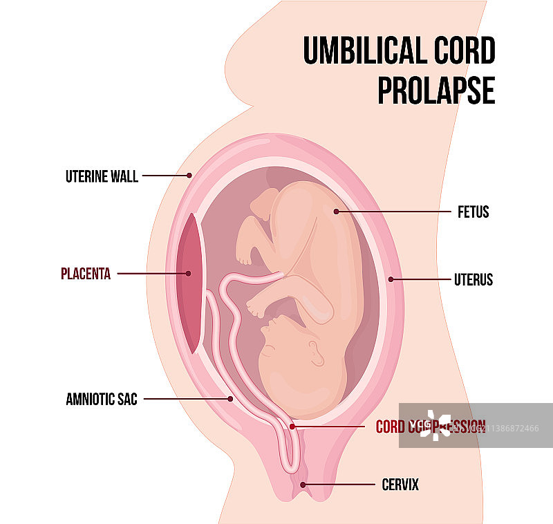 脐带脱垂医学图图片素材