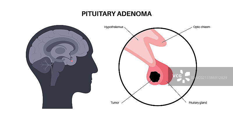 垂体腺瘤图片素材