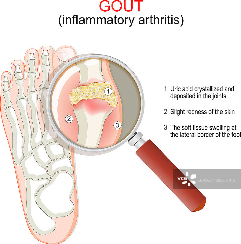 痛风性关节炎症特写图片素材