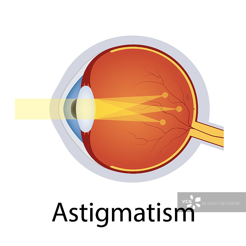 散光和视力障碍图片素材
