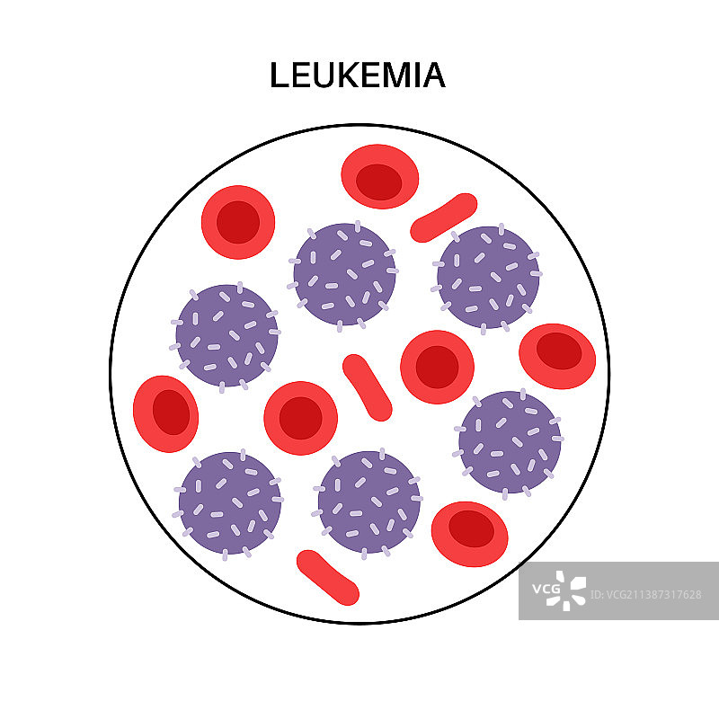 白血病图片素材
