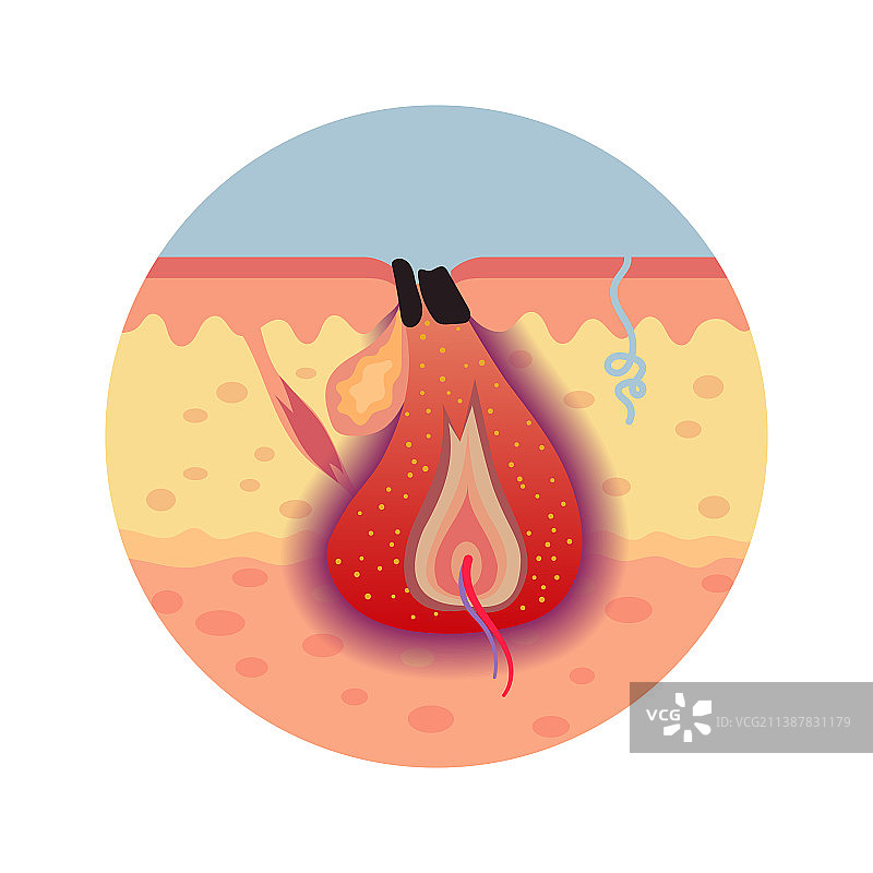 痤疮丙酸杆菌寻常型示意图图片素材