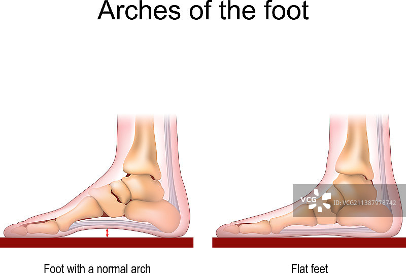 正常足弓和扁平足图片素材
