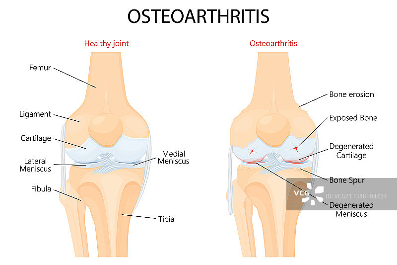 膝骨关节炎与正常关节细节图片素材