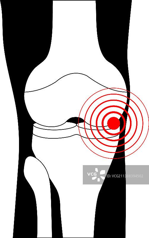 关节疼痛如膝关节骨关节炎图片素材
