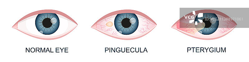 患有睑裂斑和翼状胬肉的眼睛图片素材