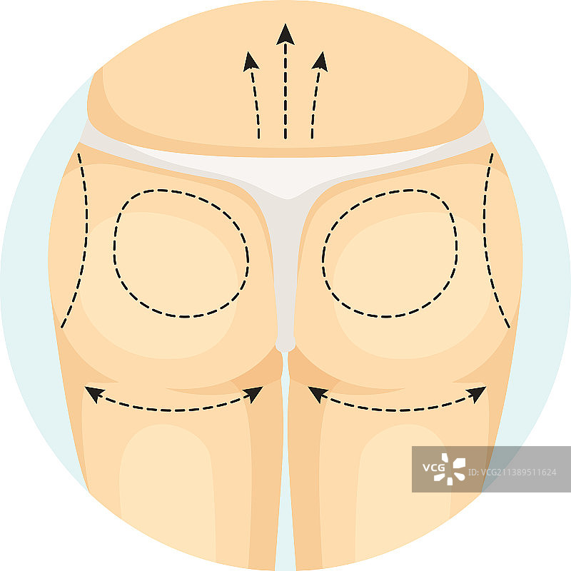 女性身体整形手术示意图图片素材