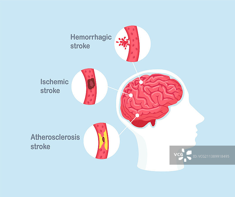 人类缺血性脑卒中类型图片素材