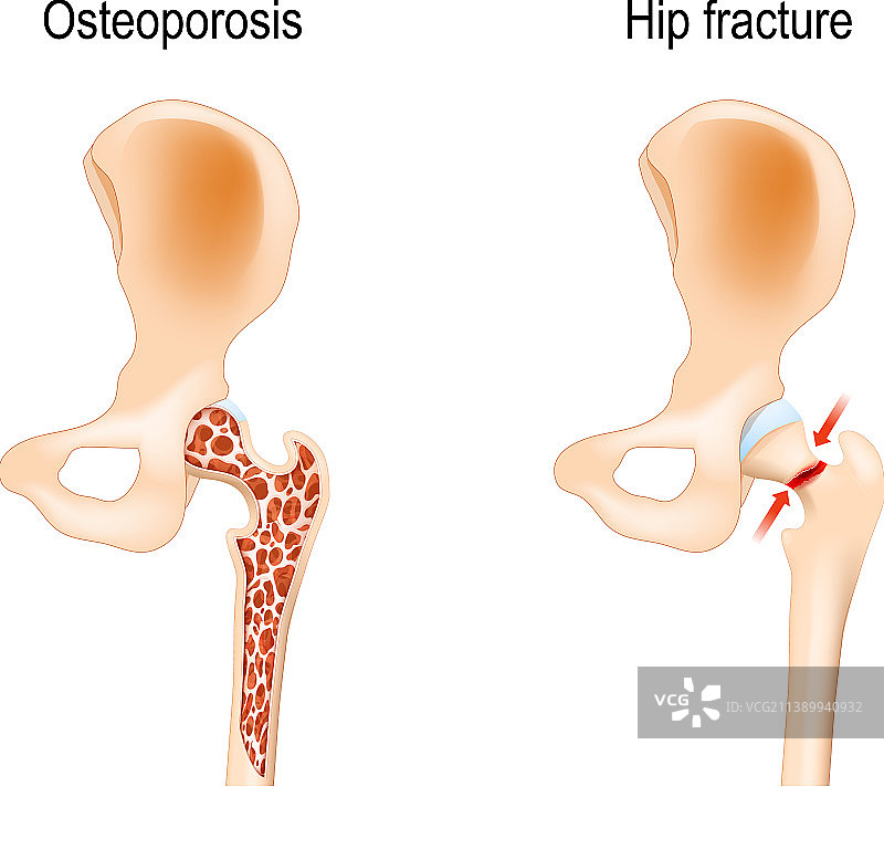 引起髋部骨折的骨质疏松症图片素材
