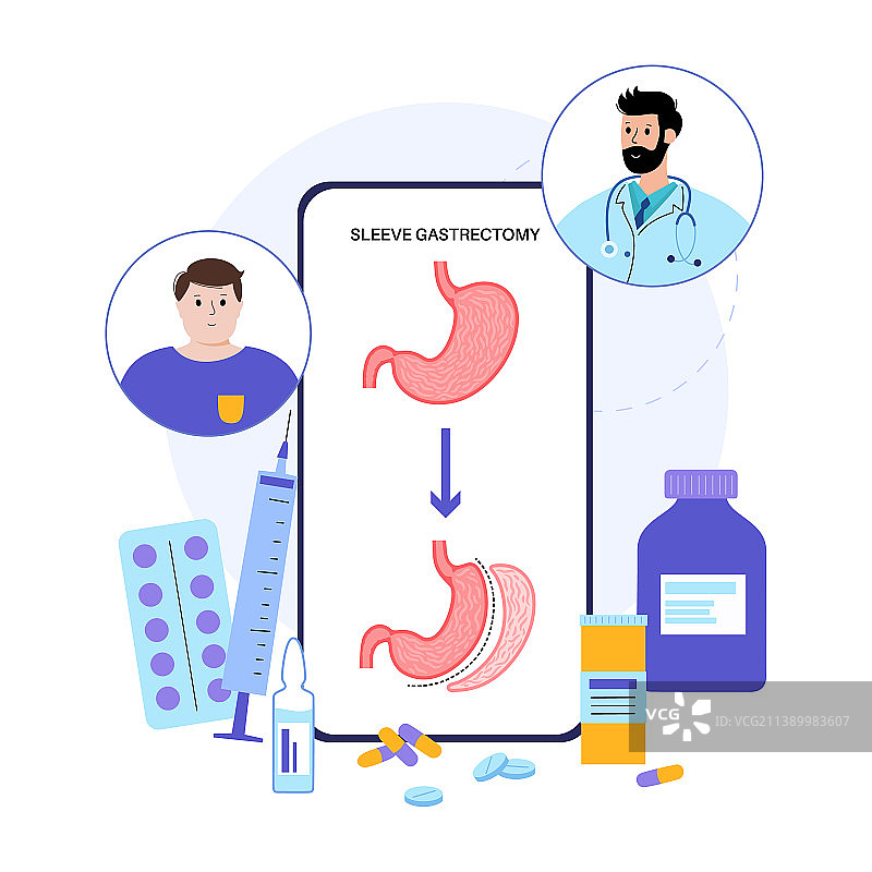 腹腔镜袖状胃切除术图片素材