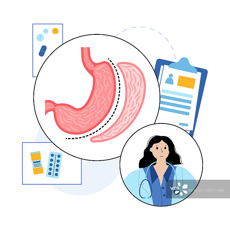 腹腔镜袖状胃切除术图片素材