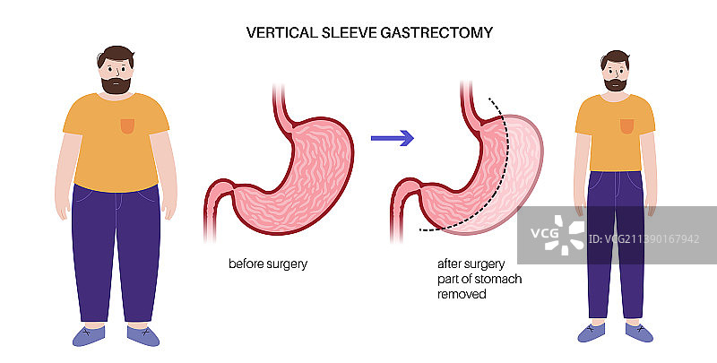 腹腔镜袖状胃切除术图片素材