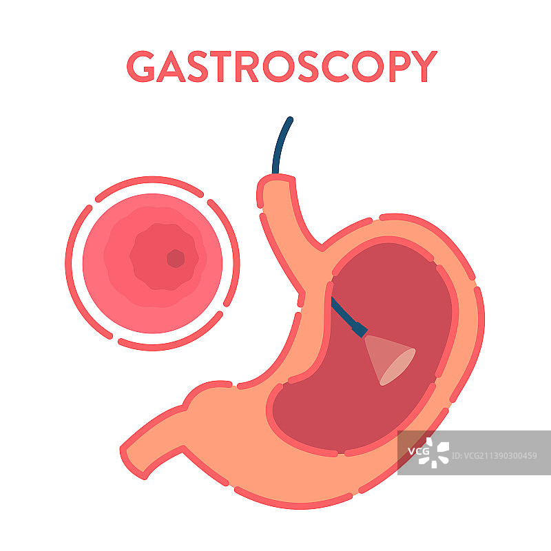 胃镜检查图片素材