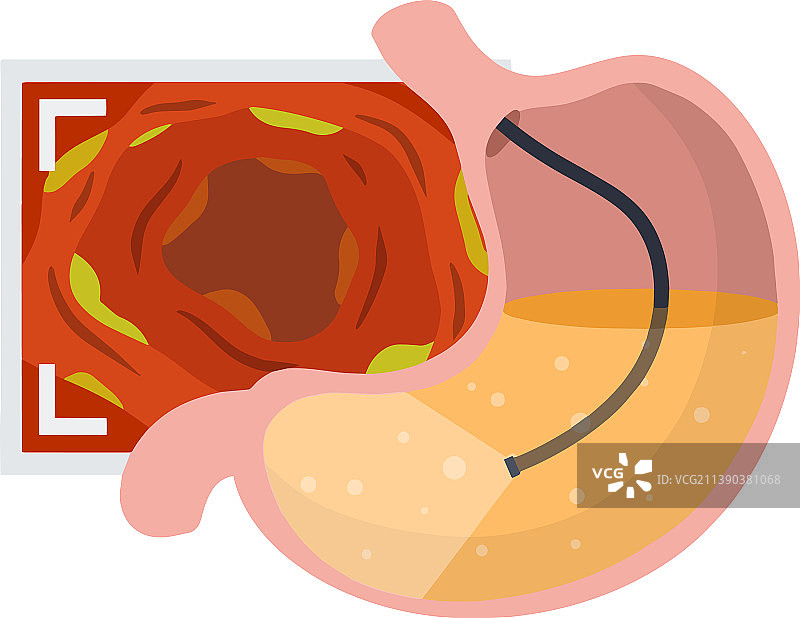 胃镜内窥镜与消化图片素材