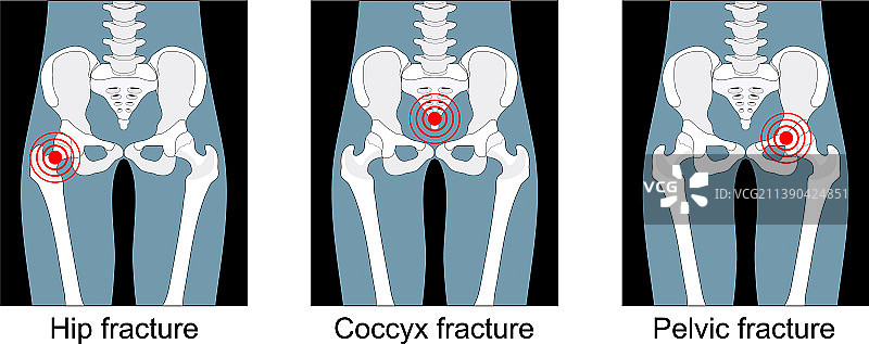 髋部、骶骨或骨盆骨折疼痛图片素材