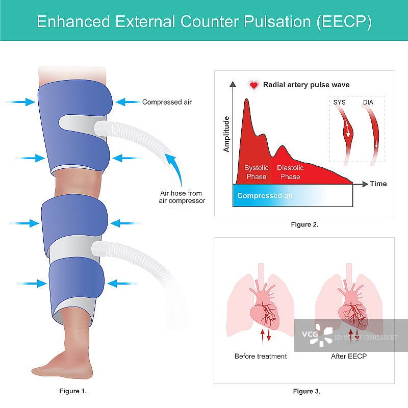 体外反搏疗法图片素材