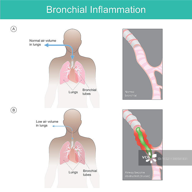 支气管炎症解释图片素材