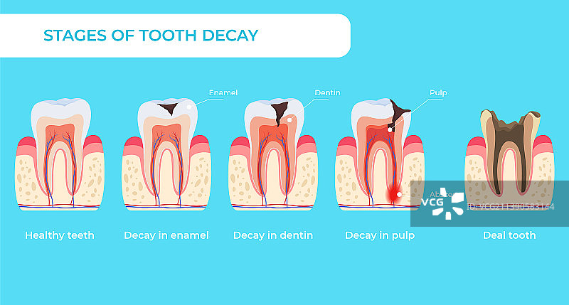 龋齿阶段信息图医学教育图片素材