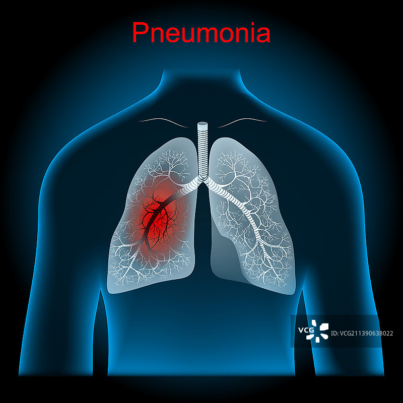 肺炎肺支气管和气管X光片图片素材
