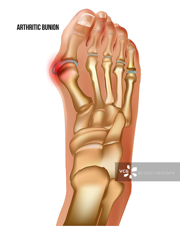 关节炎拇囊肿类风湿关节疼痛顶视图图片素材
