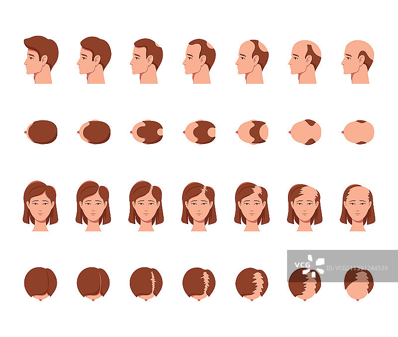 男性和女性秃顶的阶段图片素材