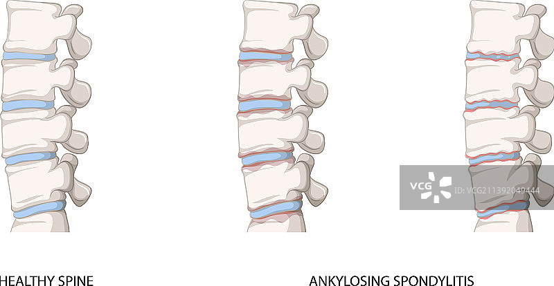 健康脊柱与强直性脊柱炎的信息图图片素材
