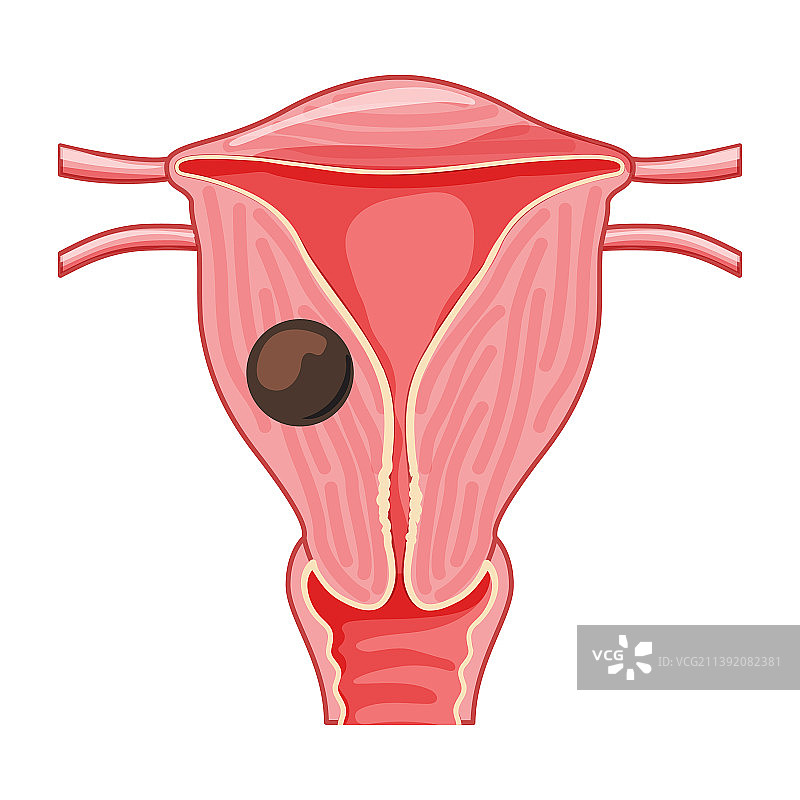 女性生殖系统腺肌瘤解剖图图片素材
