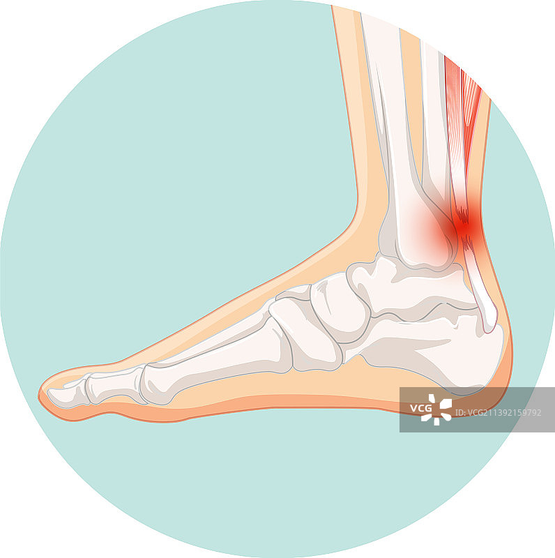 跟腱断裂圆形模板图片素材
