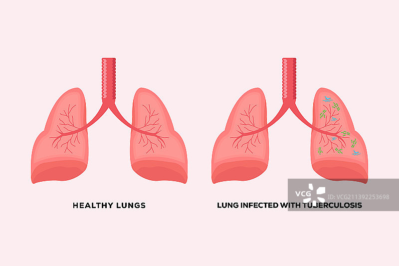 健康肺部与结核病感染的肺部图片素材