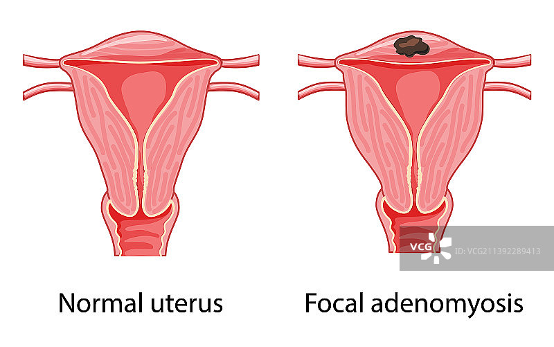 女性子宫腺肌症人体解剖图图片素材